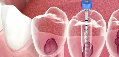 endodontic-top2