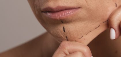 facelift-top