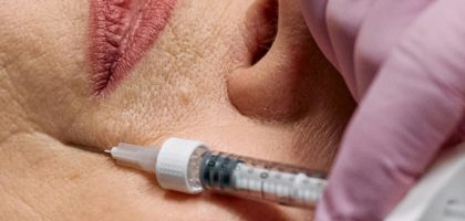facial fillers1-top1