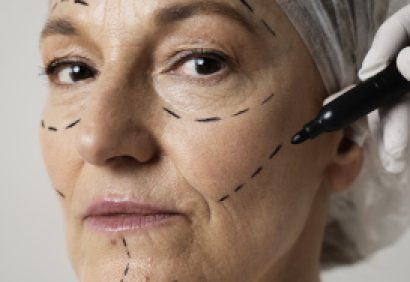 facial thread lift-scaled facial thread lift-scaled