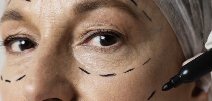 facial thread lift-top