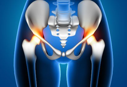 hip replacement-scaled