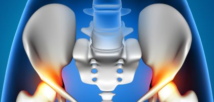 hip replacement-top