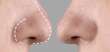 rhinoplasty-top